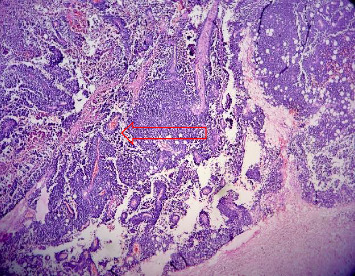 Ewing Sarcoma of the Kidney, a Rare Entity: Case Report.