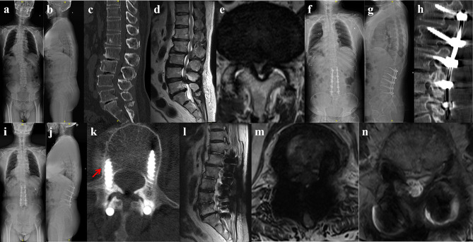 The Safety and Effectiveness of Multi-Segment Cortical Bone Trajectory Screws in Adult Degenerative Scoliosis with Stenosis Among the Elderly: Minimum 5-year Follow-up Study.