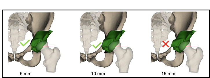 Impact of pubic cut position on pubic root displacement in periacetabular osteotomy : a 3D CT simulation study.
