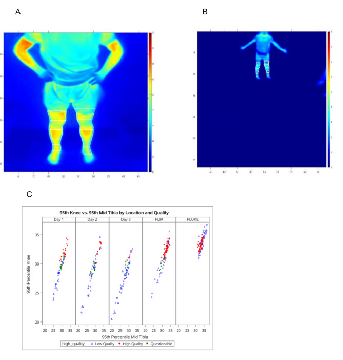Feasibility of applying infrared thermal imaging for home monitoring of arthritis in children.