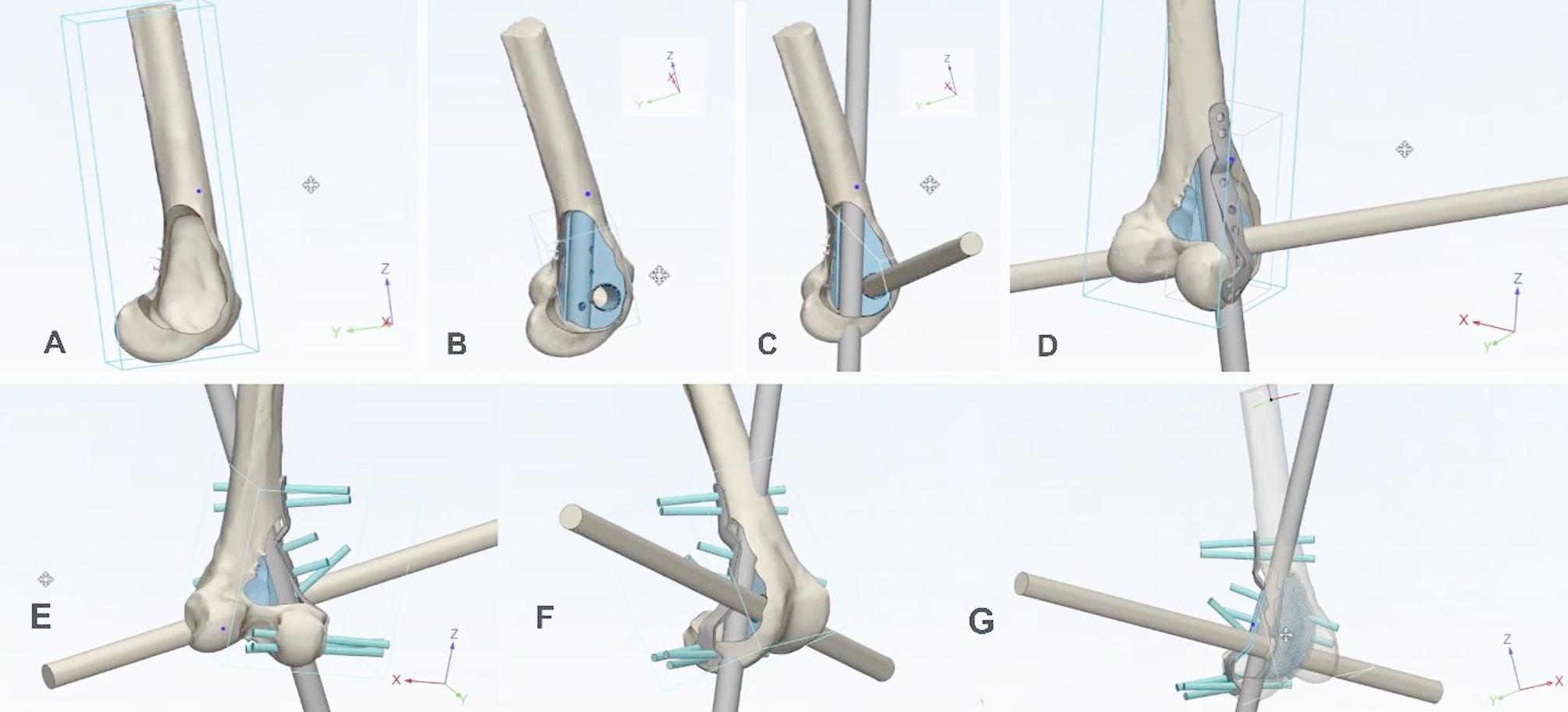 Reconstruction of a large distal femoral giant cell tumor using a 3D-printed condylar support lattice metal implant and fibular grafts: a novel biomechanical and surgical approach.