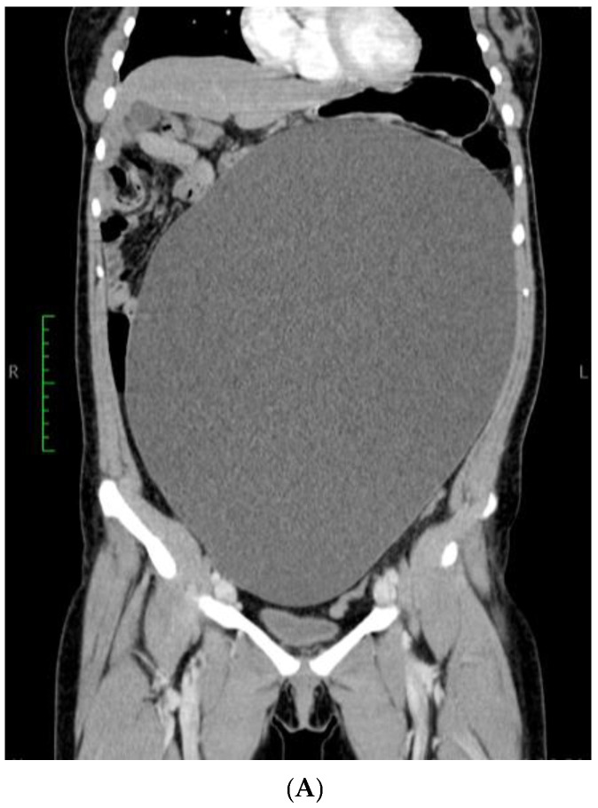 Extremely Rare Case of a Giant Paratubal Cyst, Coexisting with a Mucinous Cystadenoma, Surgically Treated Through Laparoscopy-A Case Report and Review of the Literature.