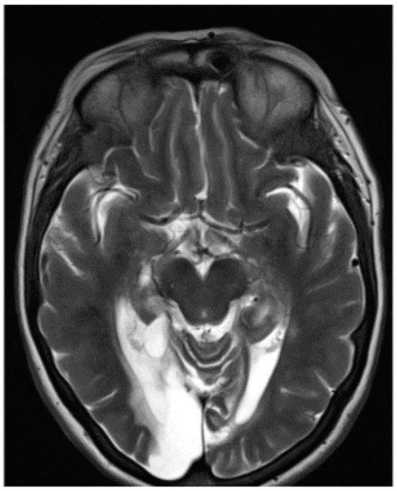 Visual Perception and Fixation Patterns in an Individual with Ventral Simultanagnosia, Integrative Agnosia and Bilateral Visual Field Loss.