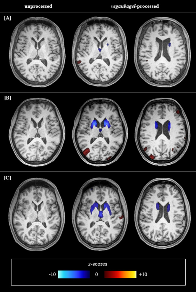 Atrophy related neuroimaging biomarkers for neurological and cognitive function in Wilson disease.