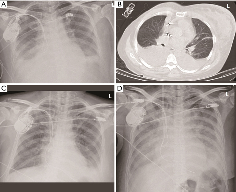 A rare complication of thrombotic microangiopathy induced by chemotherapy for second breast cancer in a Hodgkin lymphoma survivor: a case report.