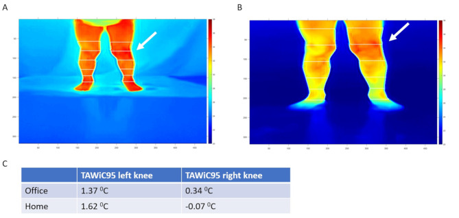 Feasibility of applying infrared thermal imaging for home monitoring of arthritis in children.