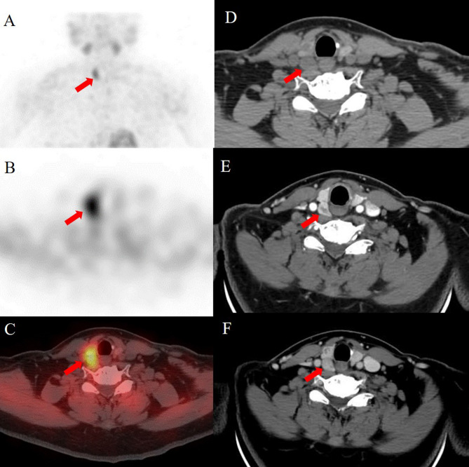 Comparison of four-dimensional CT and Sestamibi SPECTCT in the localization management of primary hyperparathyroidism.