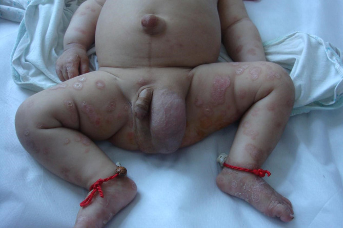 A Case of Secondary Syphilis on Infant.