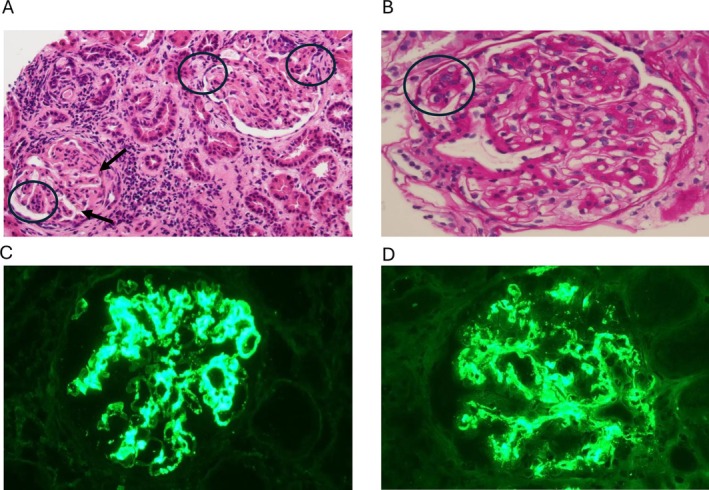 IgA Nephropathy With Membranoproliferative Pattern and Resistance to Immunosuppressive Therapy in Two Patients With Cofactor I Pathogenic Variant.