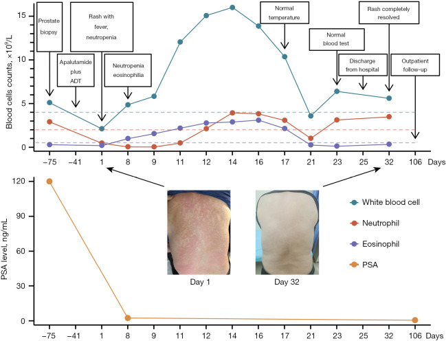 Apalutamide-associated rash combined with severe neutropenia and eosinophilia: a case report.