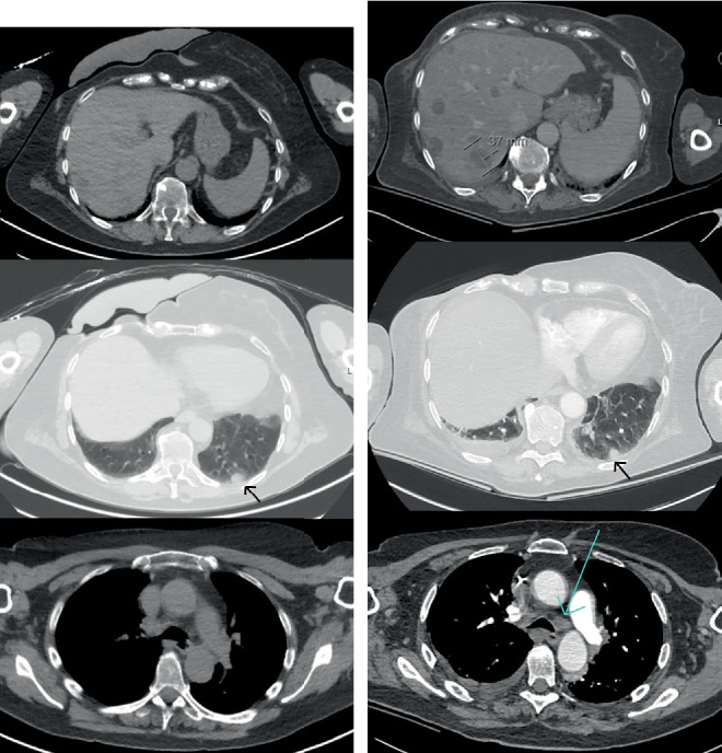 Hypercalcemia as an Immune-Related Adverse Event in a Patient Receiving Nivolumab and Ipilimumab for Metastatic Melanoma: A Case Report.