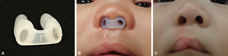 The Effectiveness of Nasal Conformers in Patients with Unilateral Cleft Lip and Palate Following Primary Cheiloplasty: A Systematic Review and Meta-Analysis.