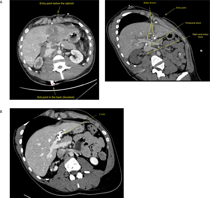 Traumatic portacaval shunt: a rare complication to be considered in patients with encephalopathy.