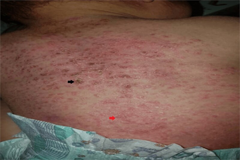 A case report of cutaneous Langerhans cell Histiocytosis in an infant: a therapeutic challenge.