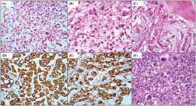 Chordoma: Site-Wise Predilections and Pathological Tenets.