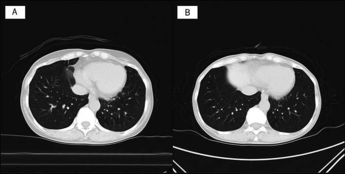 A Case of <i>Haemophilus influenzae</i> Colonisation in Bronchiectasis Following COVID-19: Post-COVID-19 Bronchiectasis as a Structural Hotbed for Chronic Airway Infections.