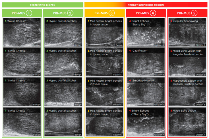 Micro-Ultrasound in the Detection of Clinically Significant Prostate Cancer: A Comprehensive Review and Comparison with Multiparametric MRI.
