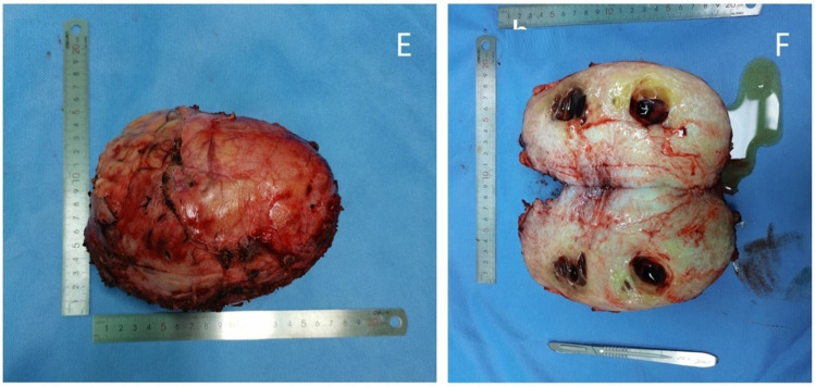 Pregnancy-Associated Giant Abdominal Desmoid Tumor: A Case Report of Active Surveillance and Surgical Management.