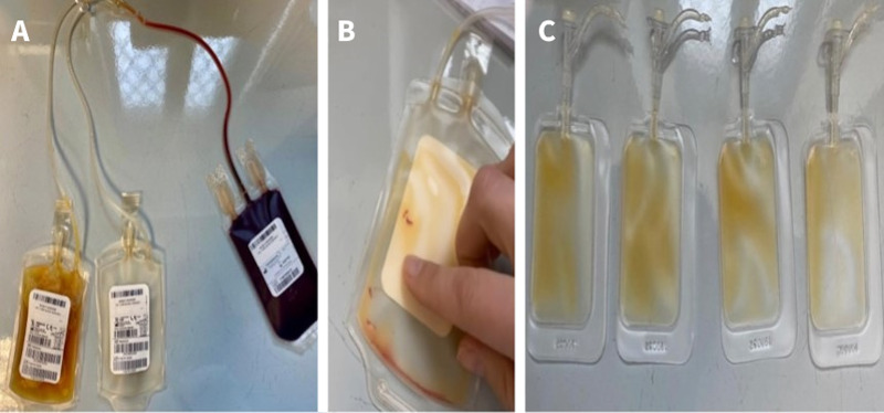 First use of cord blood platelet-rich plasma in the treatment of vulvar lichen sclerosus: a preliminary study towards a randomized controlled trial.