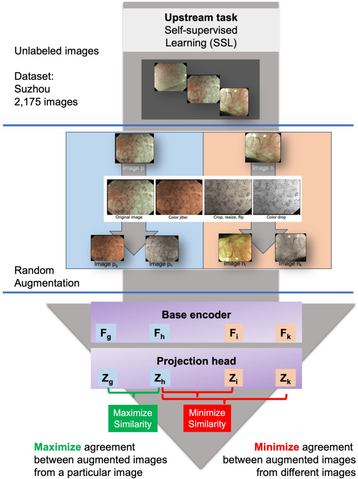 Explainable semi-supervised model for predicting invasion depth of esophageal squamous cell carcinoma based on the IPCL and AVA patterns.