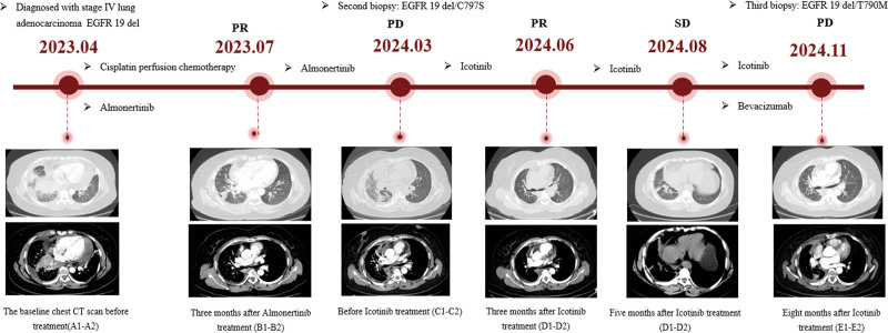 Transformation from acquired EGFR 19del/C797S to EGFR 19del/T790M in an advanced non-small cell lung cancer patient: a case report and literature review.
