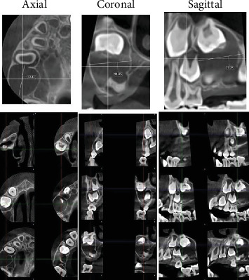 Maxillary Cystic Ameloblastic Fibroma in an 8-Year-Old Girl: A Case Report Featuring a Rare Histological Variant.