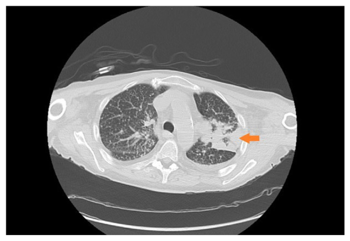Blastomycosis in a Renal Transplant Recipient: A Rare Encounter in Rural Appalachia.
