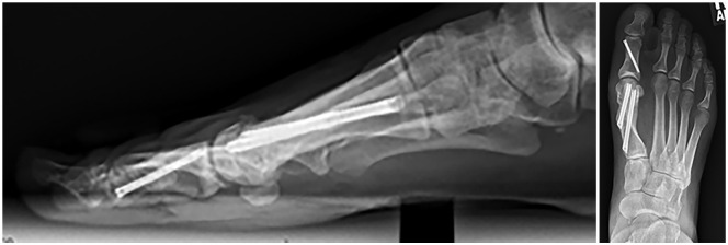 Time to Radiographic Union Following Minimally Invasive META Procedure for Hallux Valgus.