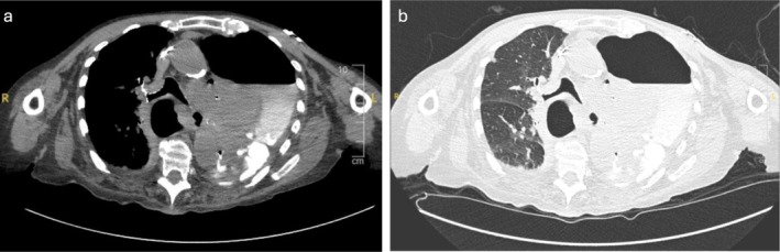 A Case of Complicated Hiatus Hernia Rupture Causing Tension Hydropneumothorax.