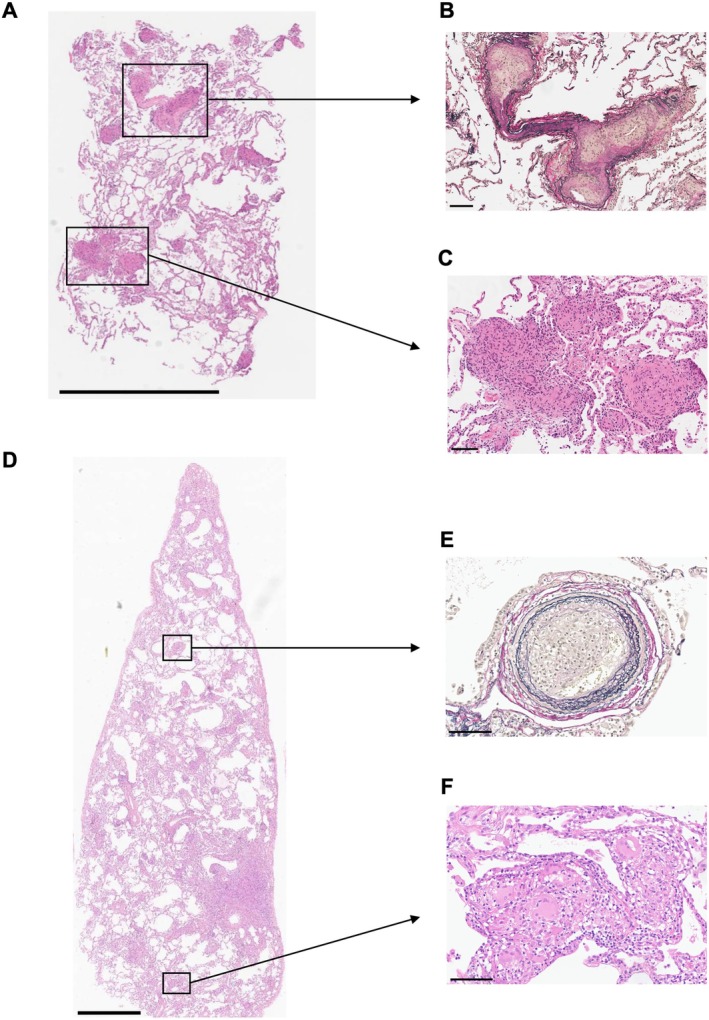 Alveolar Sarcoidosis Mimicking Idiopathic Interstitial Pneumonia Without Mediastinal Lymphadenopathy.
