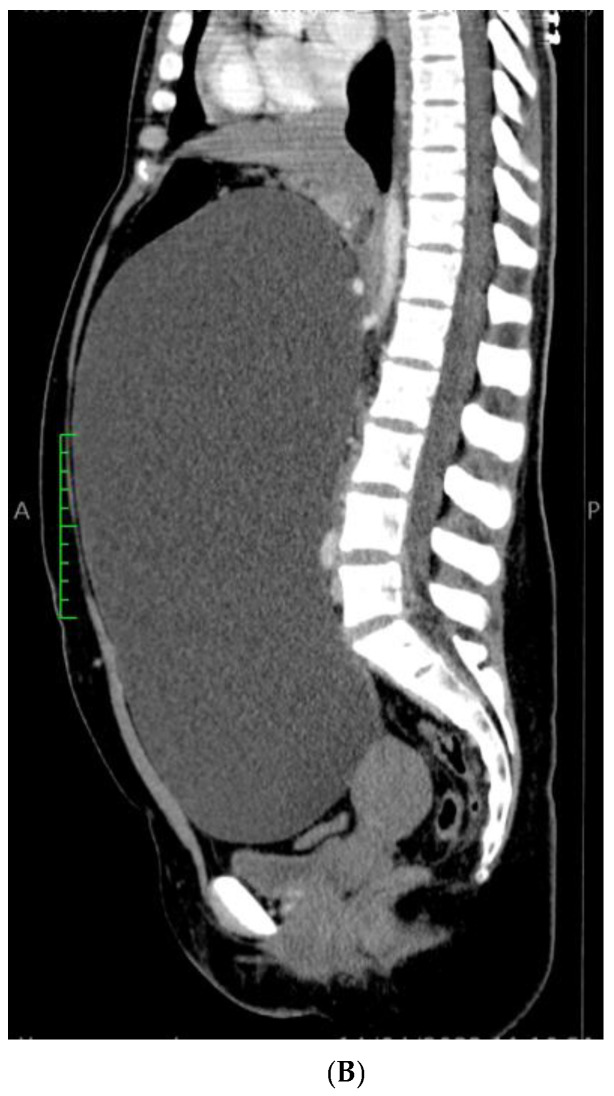 Extremely Rare Case of a Giant Paratubal Cyst, Coexisting with a Mucinous Cystadenoma, Surgically Treated Through Laparoscopy-A Case Report and Review of the Literature.