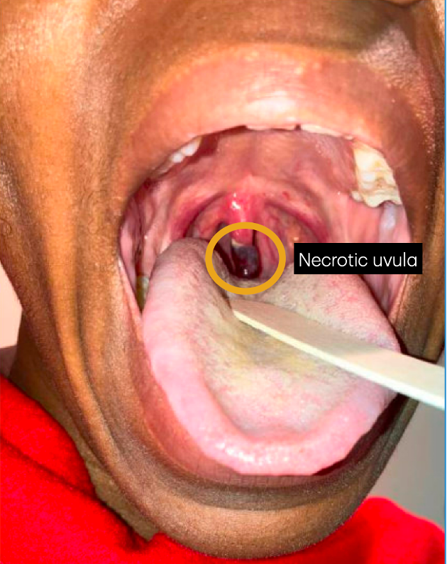 Case Report of Post-Operative Uvular Necrosis Following Intubation.