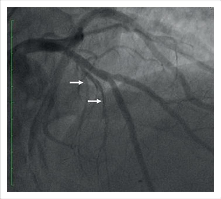 Septal Artery Embolization with Onyx® In Hypertrophic Cardiomyopathy: Report of Two Cases.