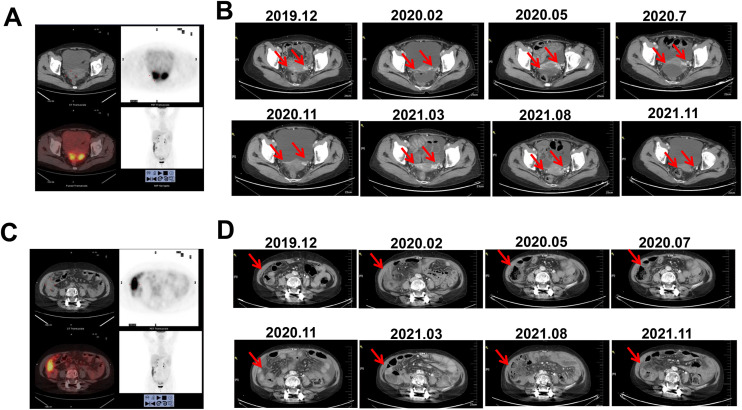 A stage IV high-grade serous ovarian cancer patient carrying <i>ERBB2</i> amplification and ERBB2 overexpression benefits from late-line pyrotinib treatment: A case report.