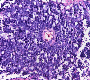 Ewing Sarcoma of the Kidney, a Rare Entity: Case Report.