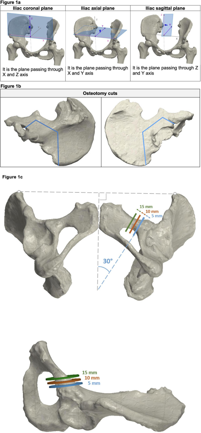 Impact of pubic cut position on pubic root displacement in periacetabular osteotomy : a 3D CT simulation study.