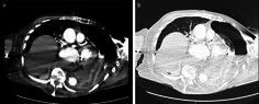A Case of Complicated Hiatus Hernia Rupture Causing Tension Hydropneumothorax.