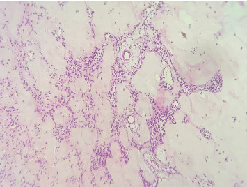 Maxillary Cystic Ameloblastic Fibroma in an 8-Year-Old Girl: A Case Report Featuring a Rare Histological Variant.