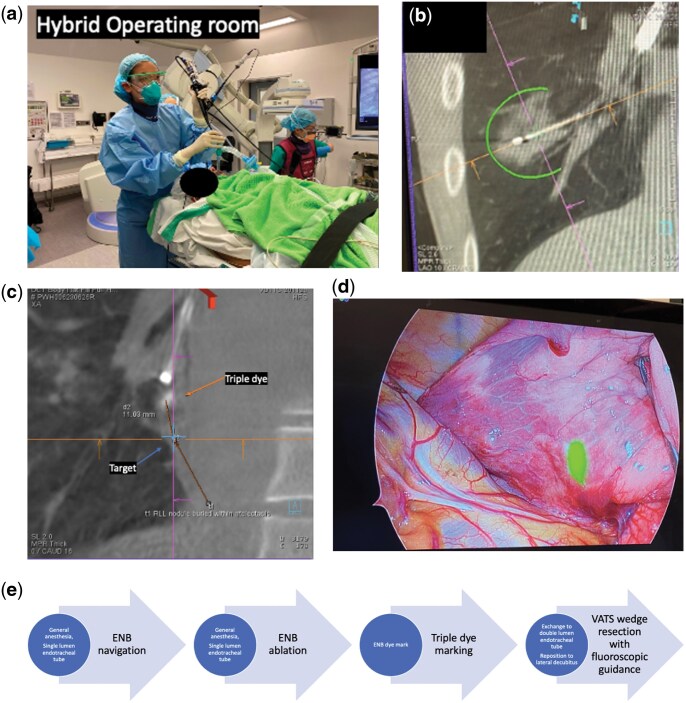 Hybrid treatment of multifocal lung malignancy by concomitant transbronchial microwave ablation with same-session lung resection and post-lung resection ablation.