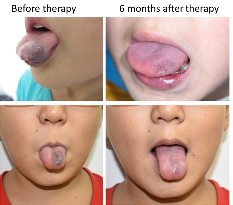 Sclerotherapy With Polidocanol Is Highly Effective for Treating Oral Cavernous Hemangiomas in Children.