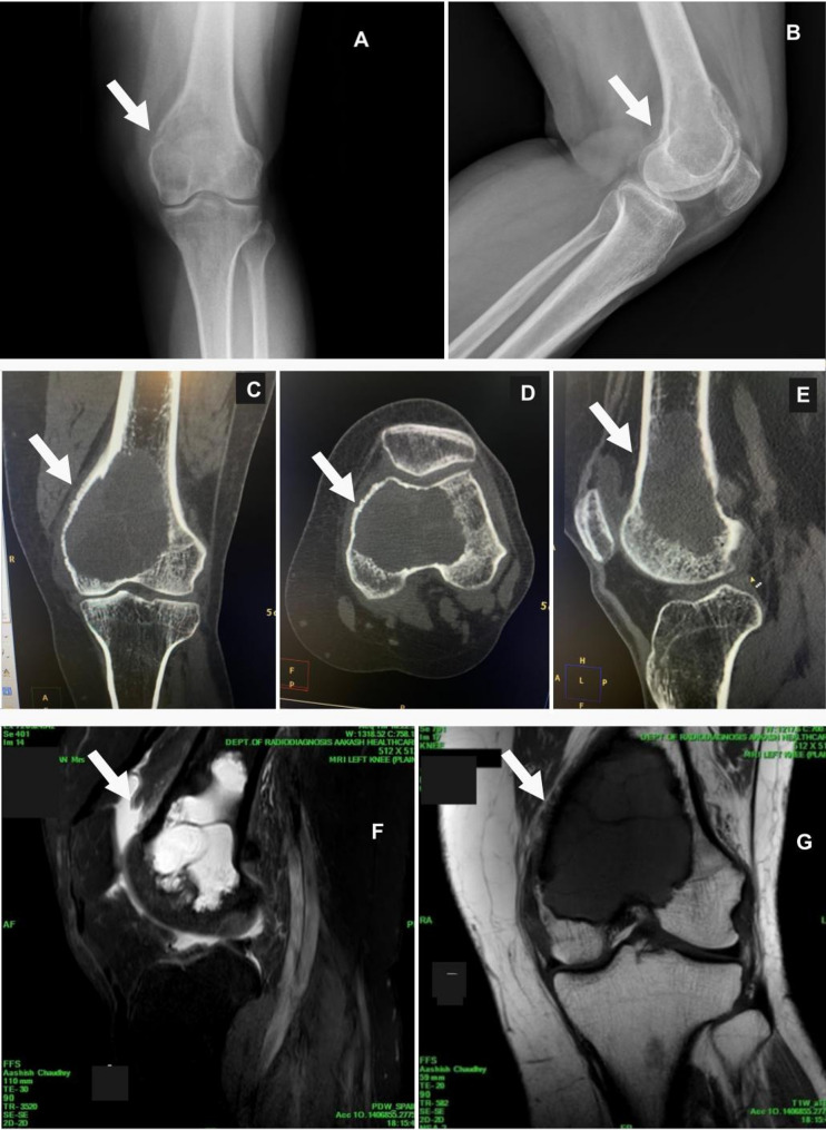 Reconstruction of a large distal femoral giant cell tumor using a 3D-printed condylar support lattice metal implant and fibular grafts: a novel biomechanical and surgical approach.