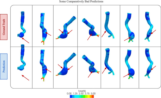 Rapid wall shear stress prediction for aortic aneurysms using deep learning: a fast alternative to CFD.