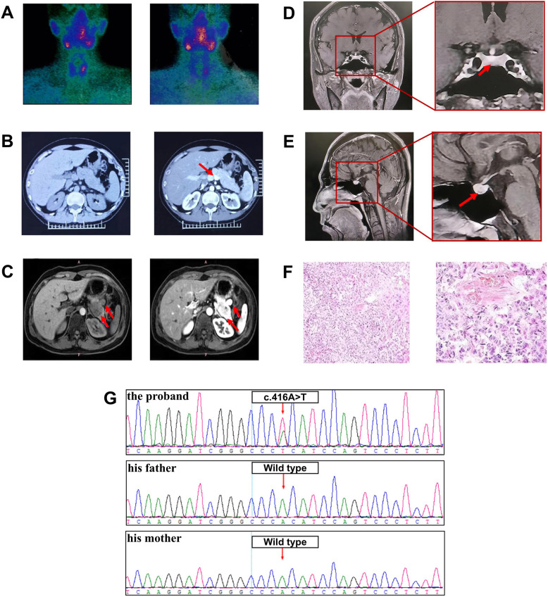 Multiple endocrine neoplasia type 1 with neuroglycopenic symptoms with a novel heterozygous MEN1 gene mutation.