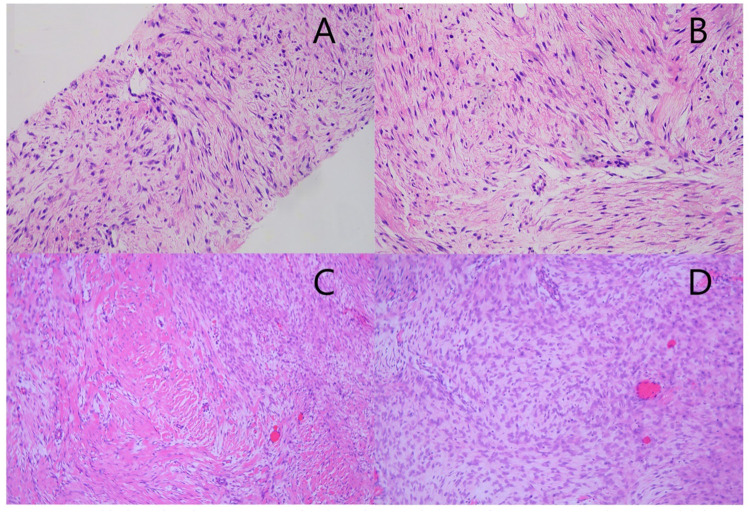 Pregnancy-Associated Giant Abdominal Desmoid Tumor: A Case Report of Active Surveillance and Surgical Management.