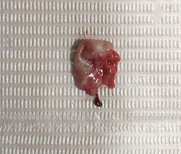 Maxillary Cystic Ameloblastic Fibroma in an 8-Year-Old Girl: A Case Report Featuring a Rare Histological Variant.