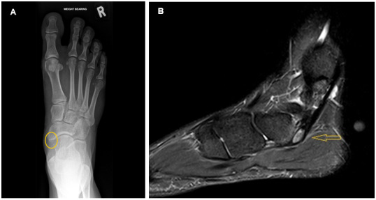 Case report - midfoot pain in a collegiate athlete with polycystic ovaries: digging deeper into bones and hormones.