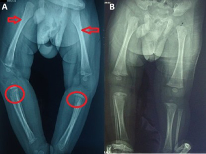 A Case of Secondary Syphilis on Infant.