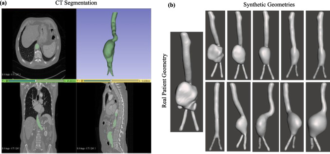 Rapid wall shear stress prediction for aortic aneurysms using deep learning: a fast alternative to CFD.