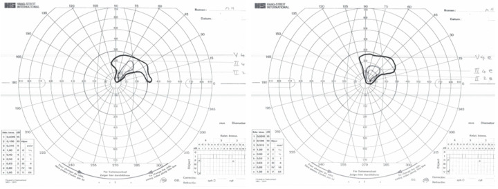 Visual Perception and Fixation Patterns in an Individual with Ventral Simultanagnosia, Integrative Agnosia and Bilateral Visual Field Loss.