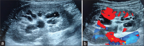 Renal sinus lymphangiectasia: An uncommon entity.